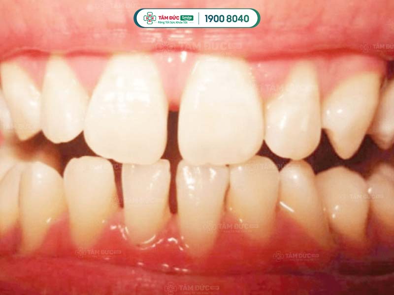 Răng thưa hàm dưới do nhiều nguyên nhân như mất răng, phản xạ nuốt không chính xác...