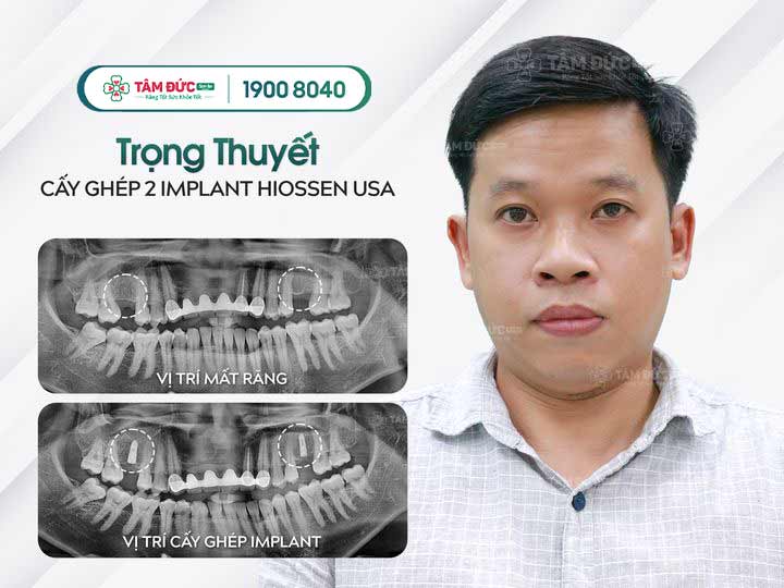 Anh Thuyết sau khi trồng răng Implant tại nha khoa casino online uy tín



